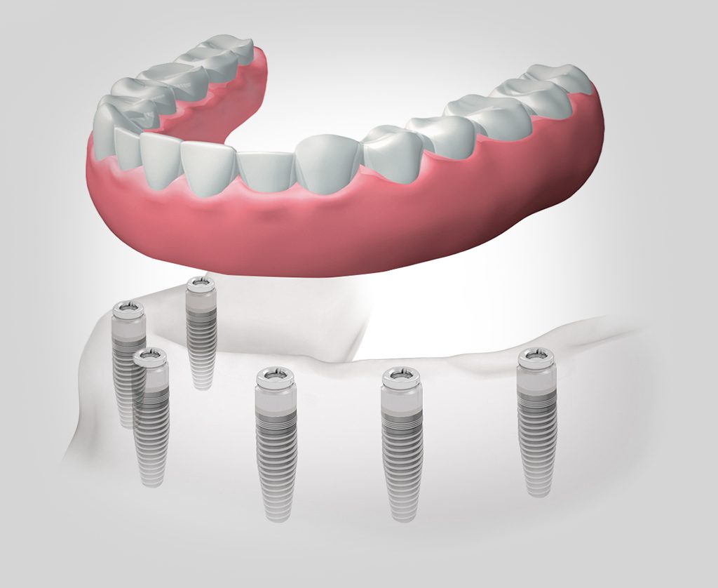 implantes dentales en León