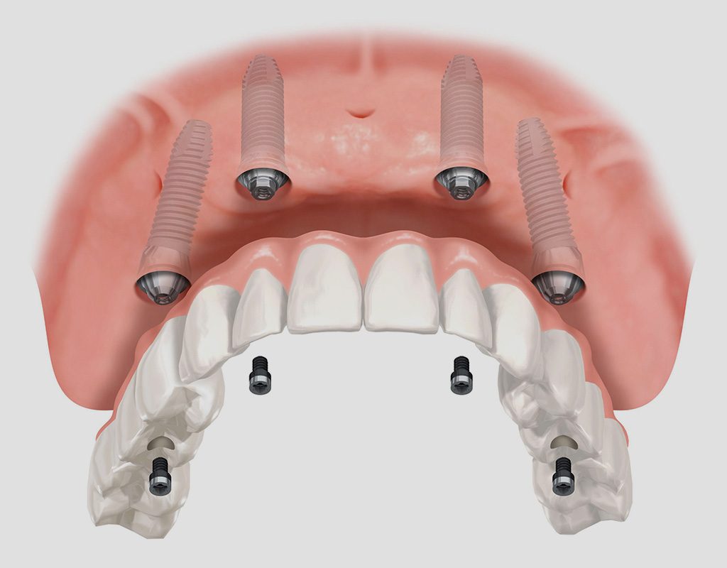 implantes dentales en León
