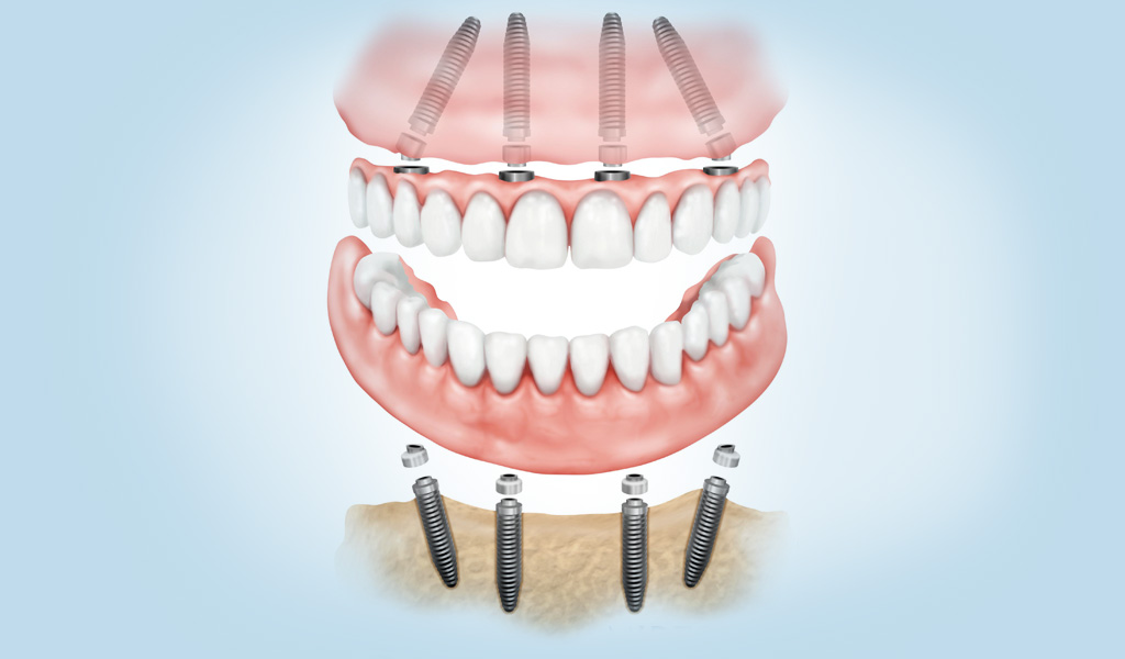 implantes dentales en León