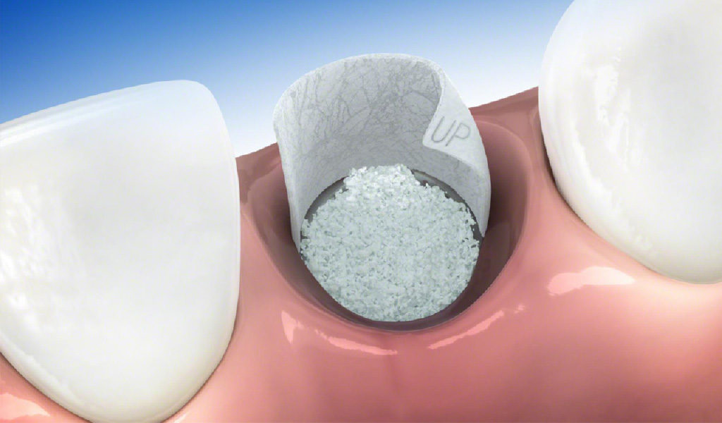 implantes dentales en León