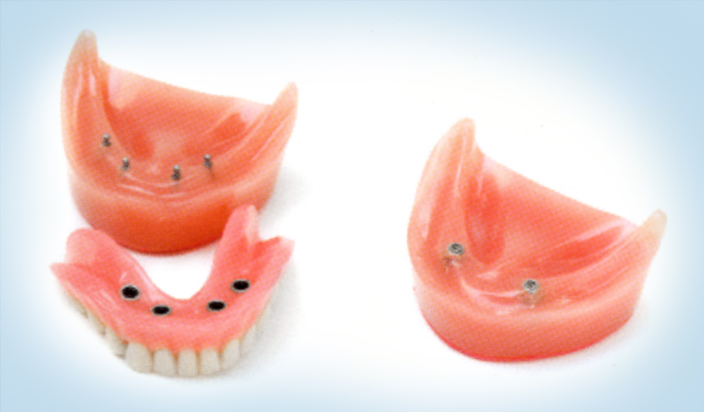 implantes dentales en León