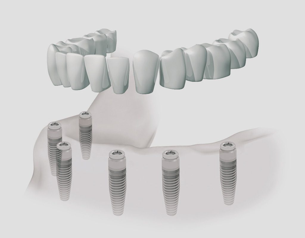 implantes dentales en León