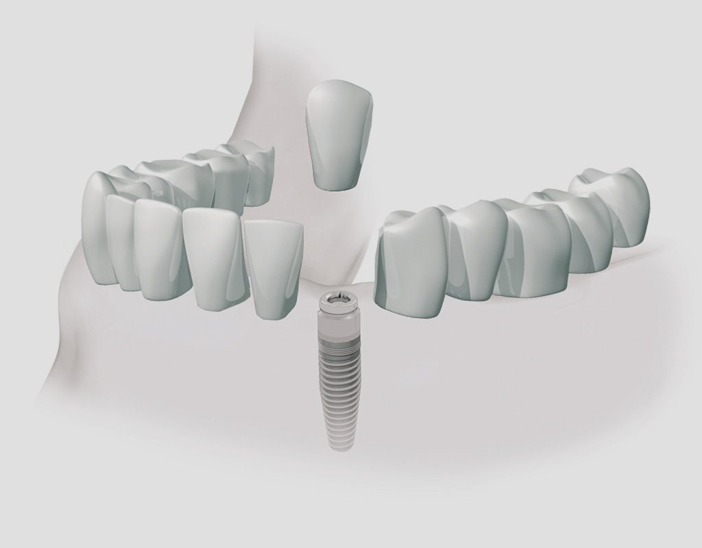 implantes dentales en León